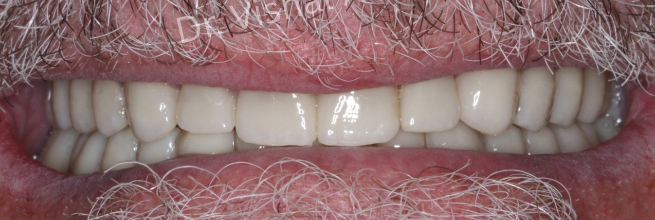 Single implant restoration with surrounding natural teeth
