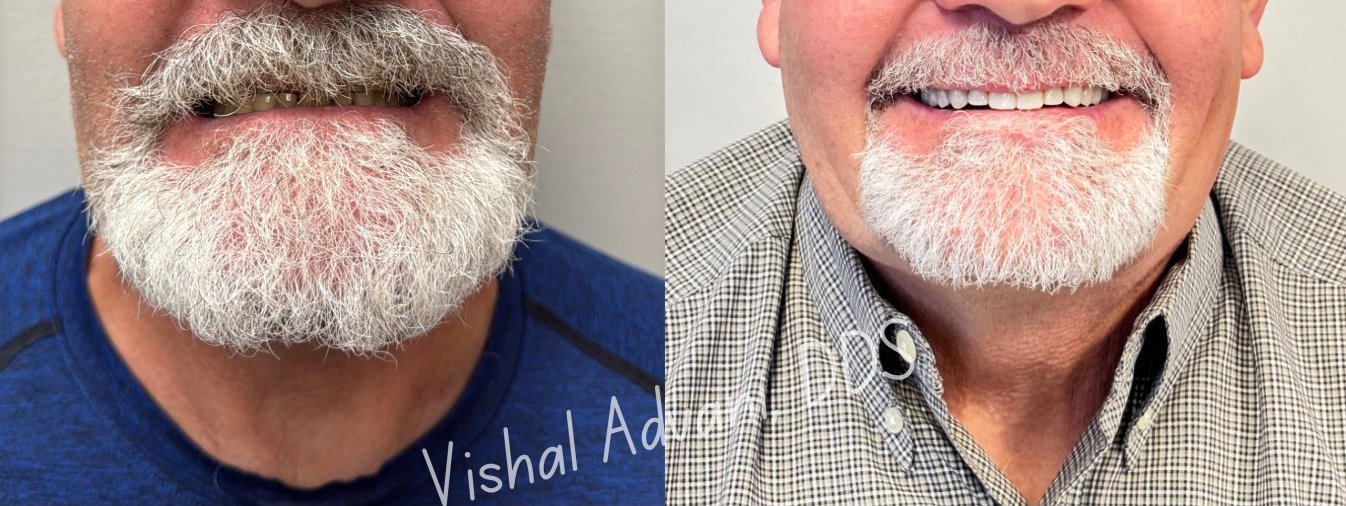 Single tooth implant final result