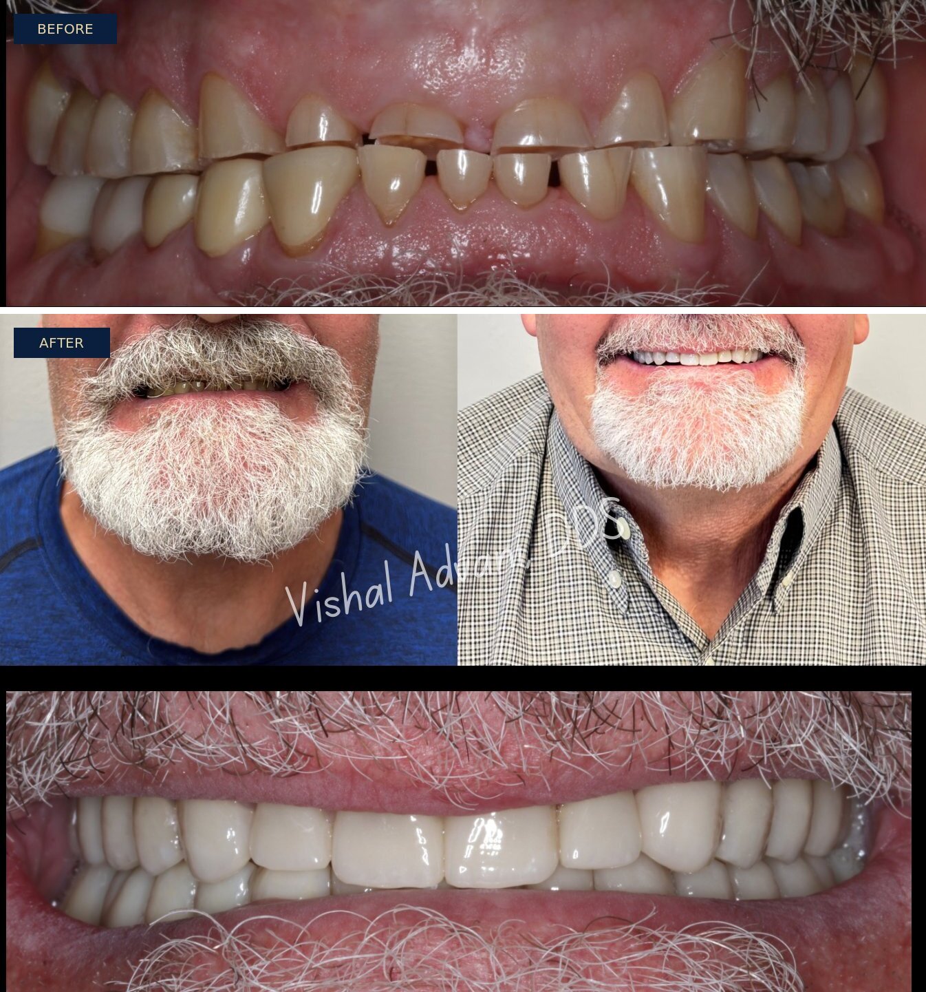 Worn Dentition Rehabilitation — before and after full-arch dental implants by Dr. Vishal Advani