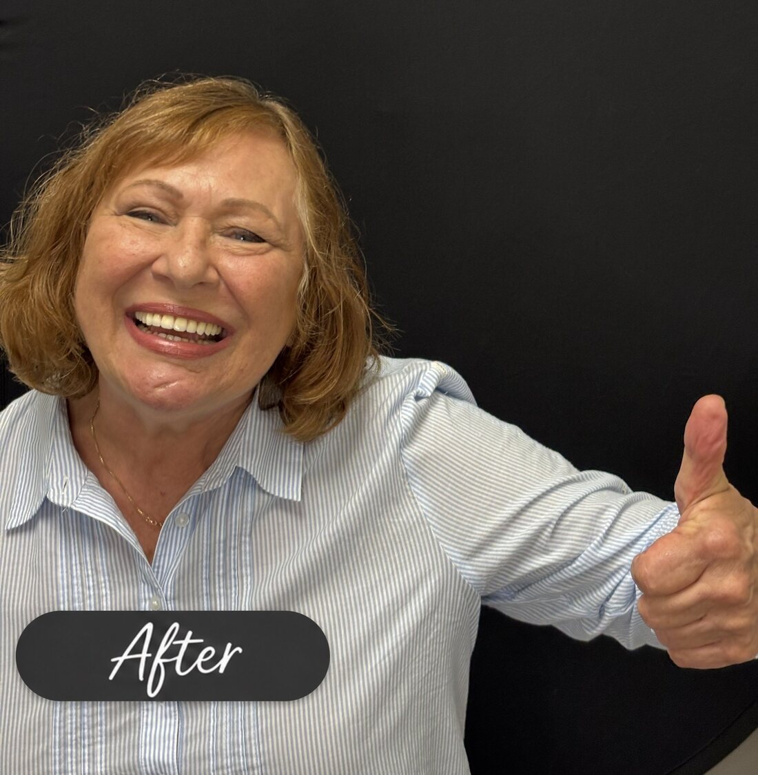 Anna giving a thumbs up after her full-arch dental implant treatment