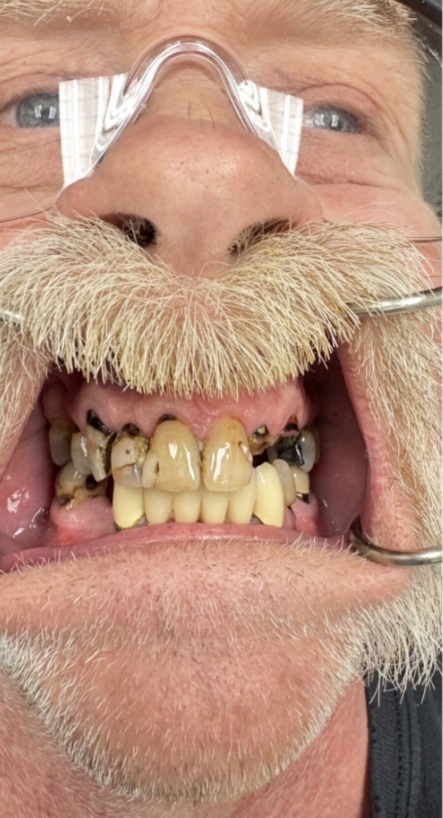 David before full mouth dental implants: broken and decayed upper and lower teeth