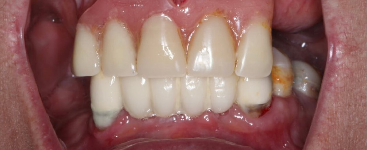 Close-up before: Dominika's failing upper bridge, broken teeth and inflamed gums