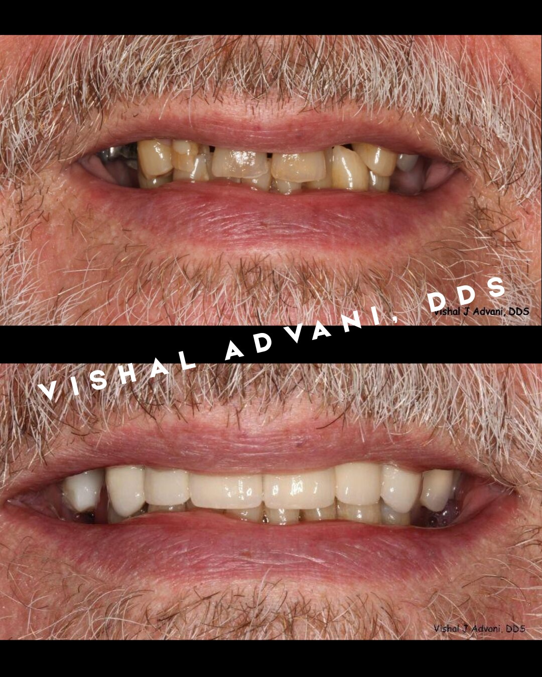 Upper smile restoration before and after