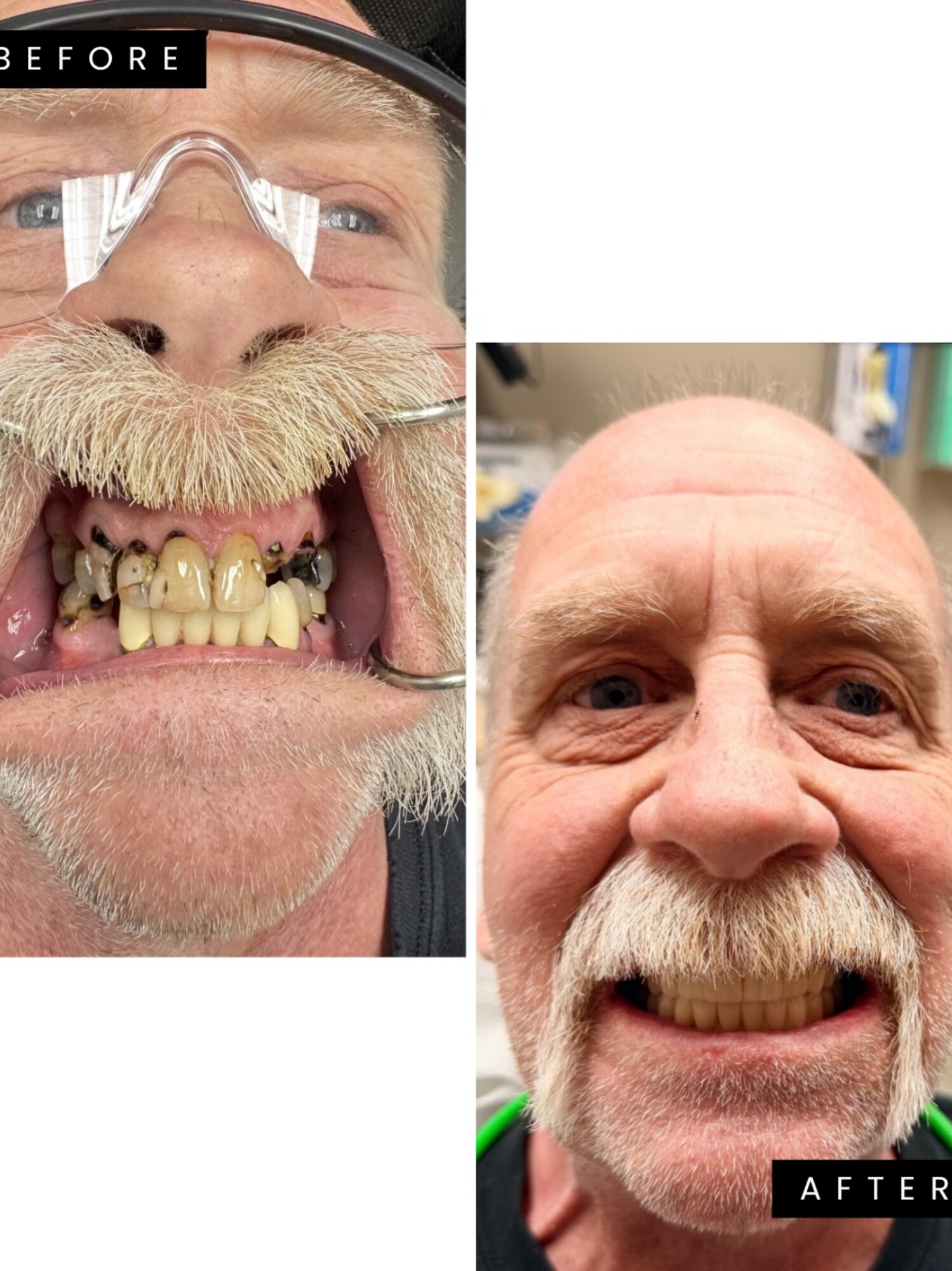 Full-face patient transformation — before and after FP1 upper arch reconstruction