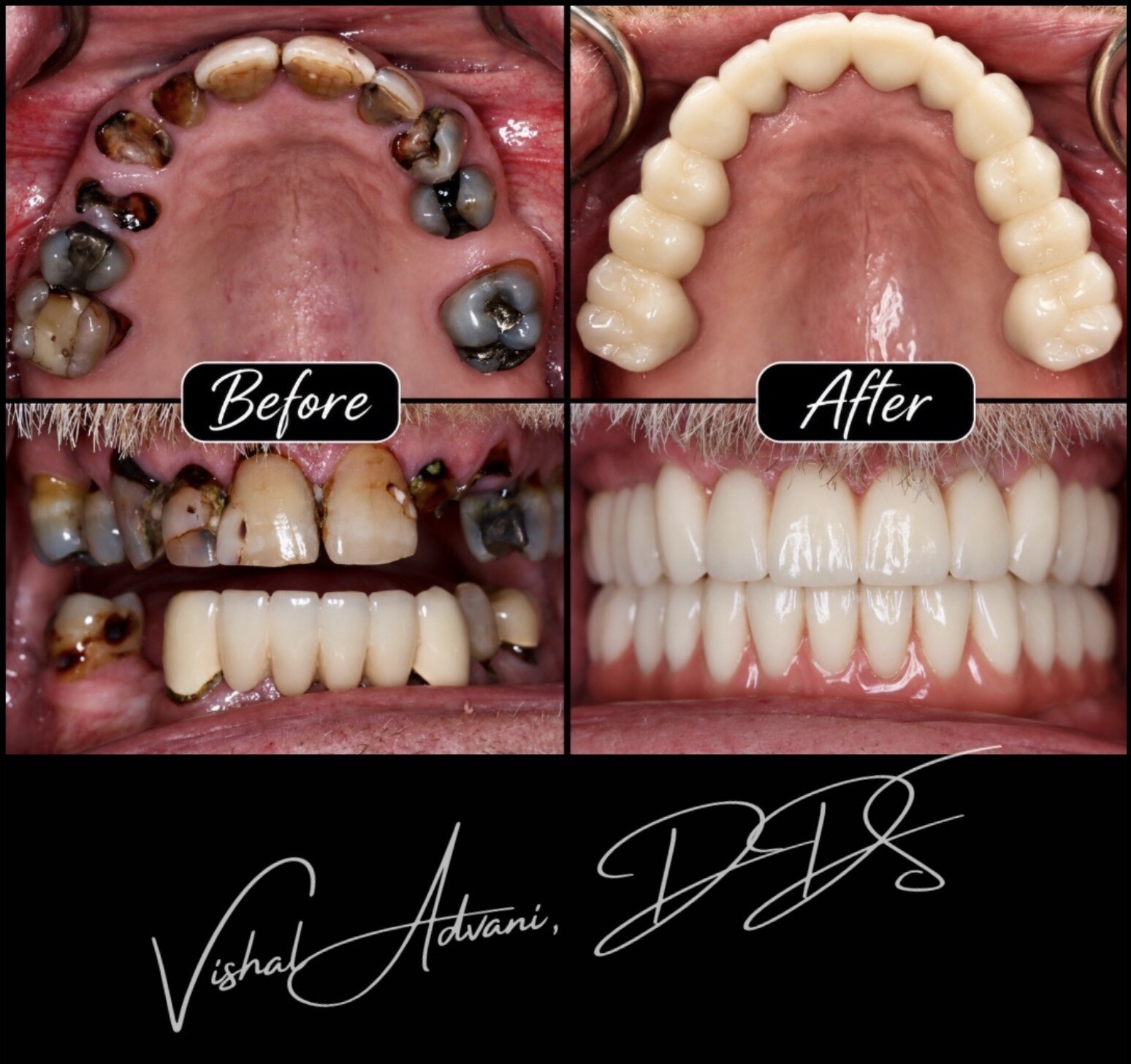 Advani A6™ result — upper arch restored with teeth that emerge from the patient's own natural gum tissue, no pink prosthetic material