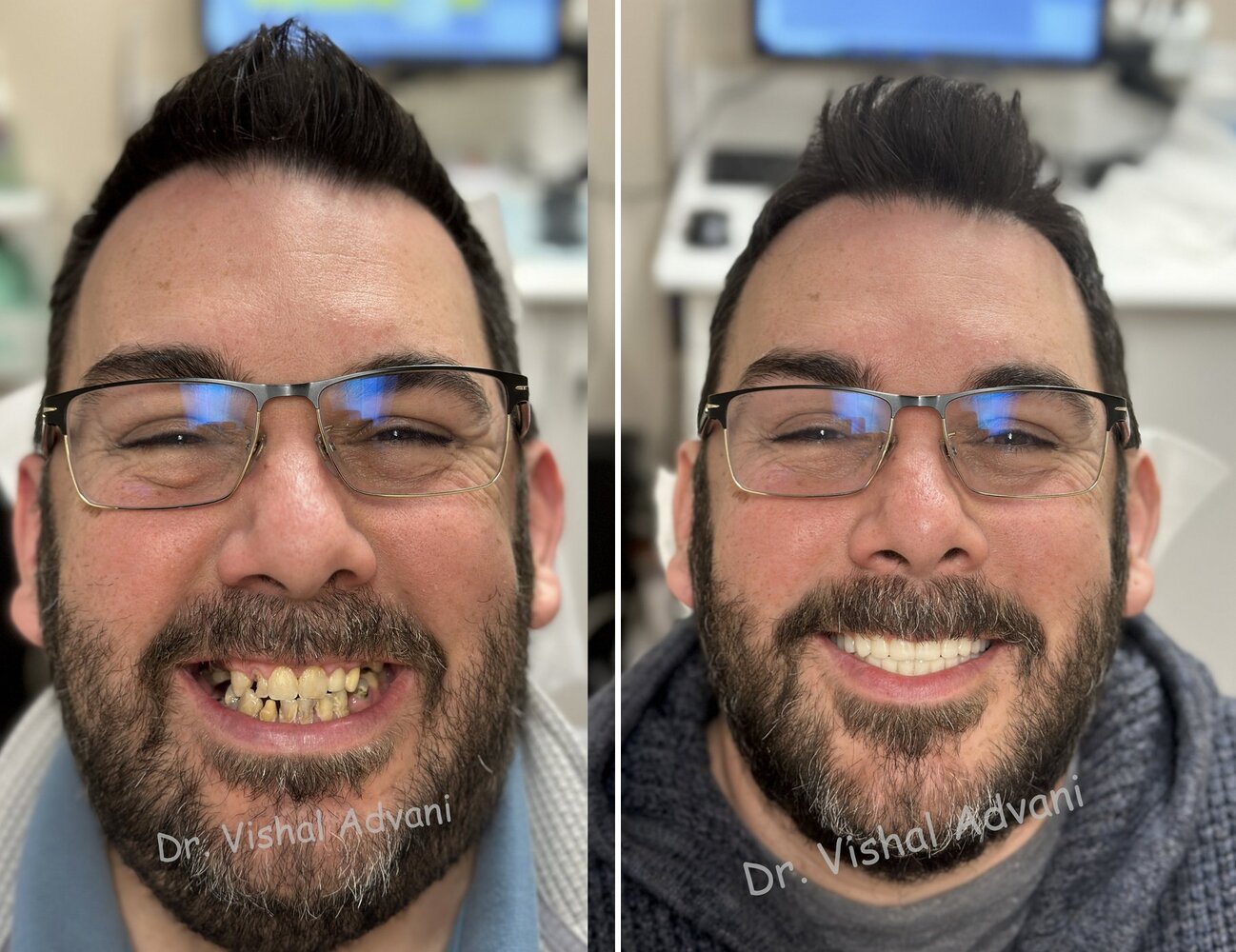 Upper Full-Arch Restoration — before and after full-arch dental implants by Dr. Vishal Advani