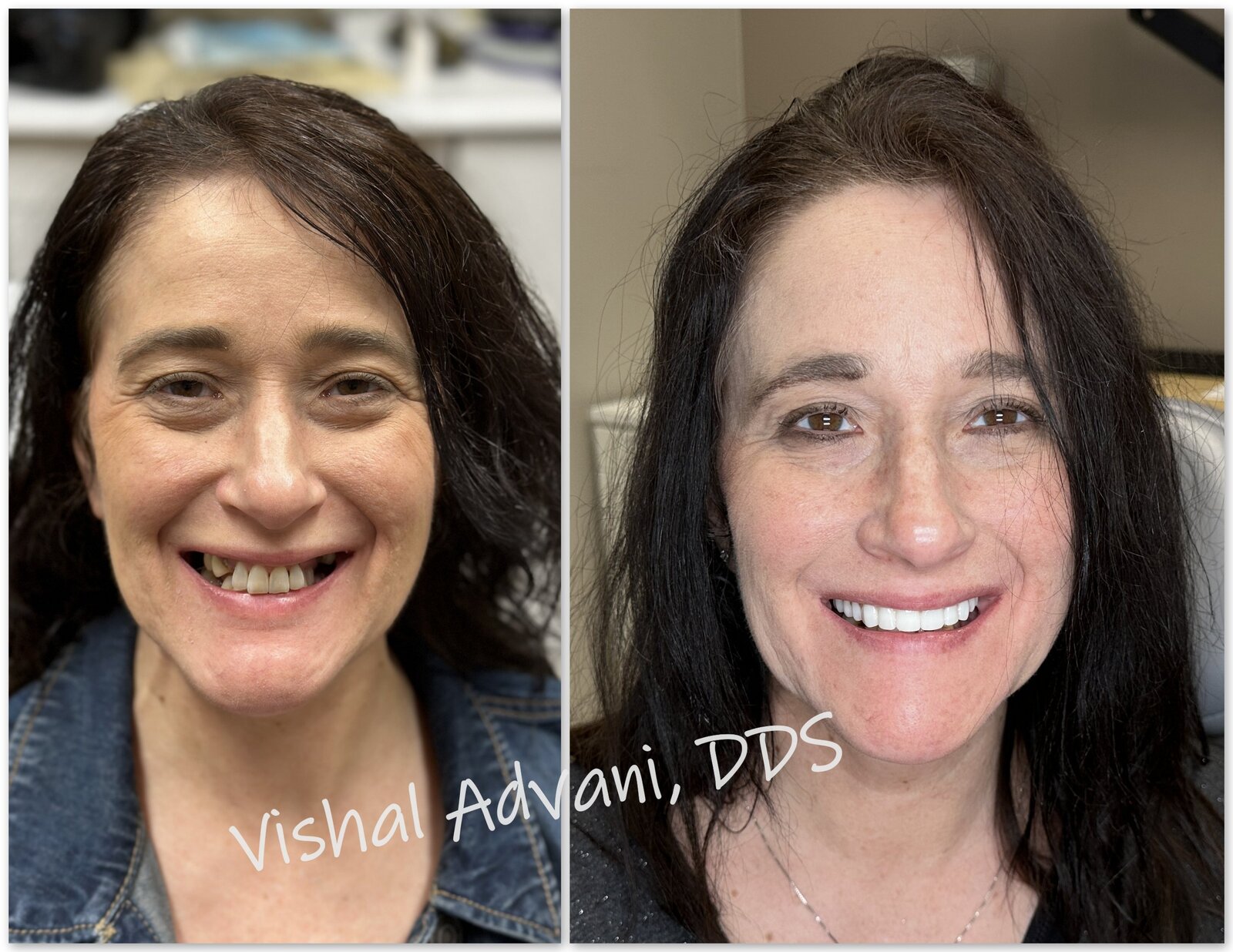 Patient before and after smile transformation by Dr. Vishal Advani