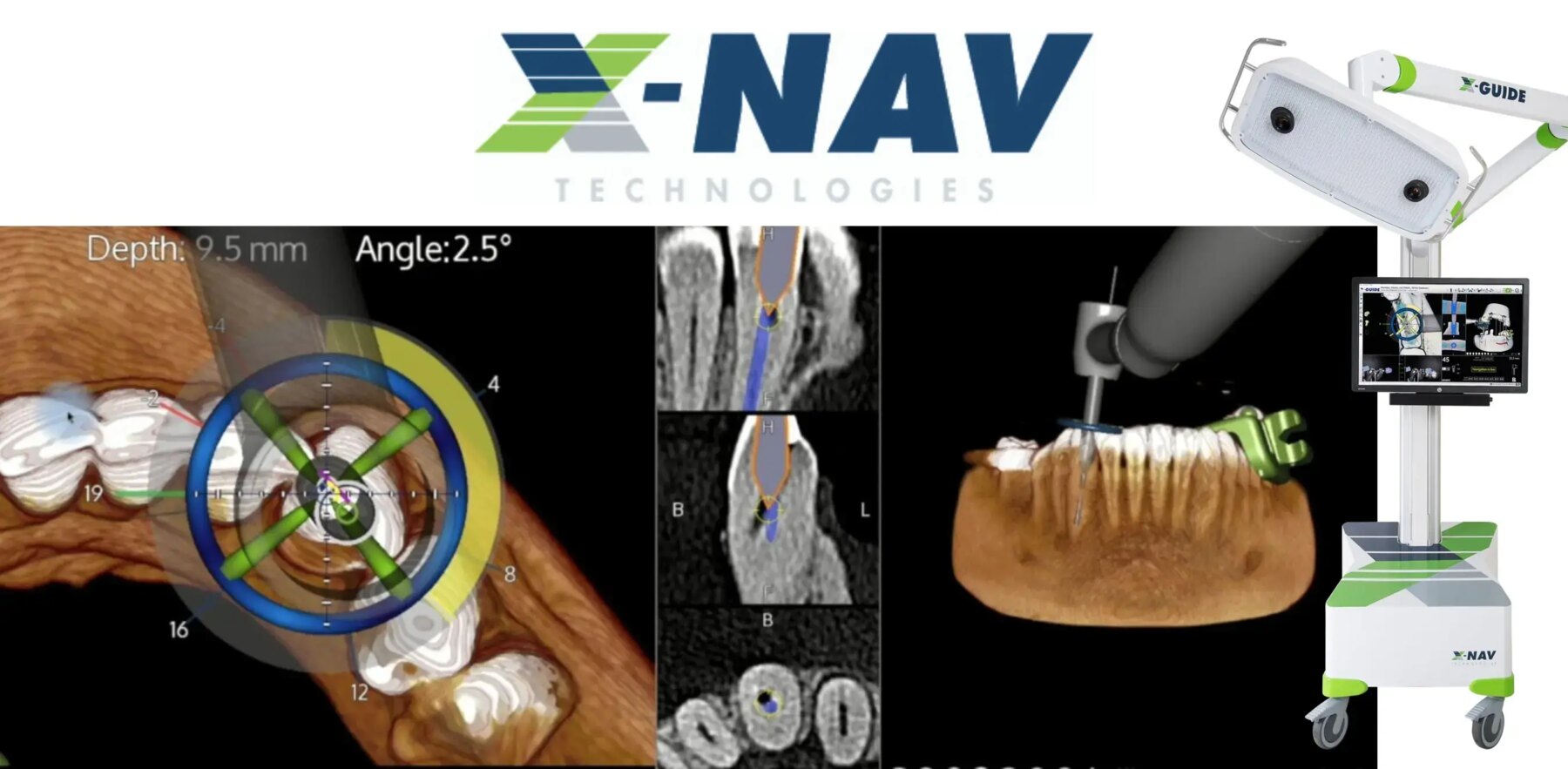 X-Nav X-Guide dynamic navigation system — live 3D navigation screen showing drill depth and angle, and the X-Guide tracking cart